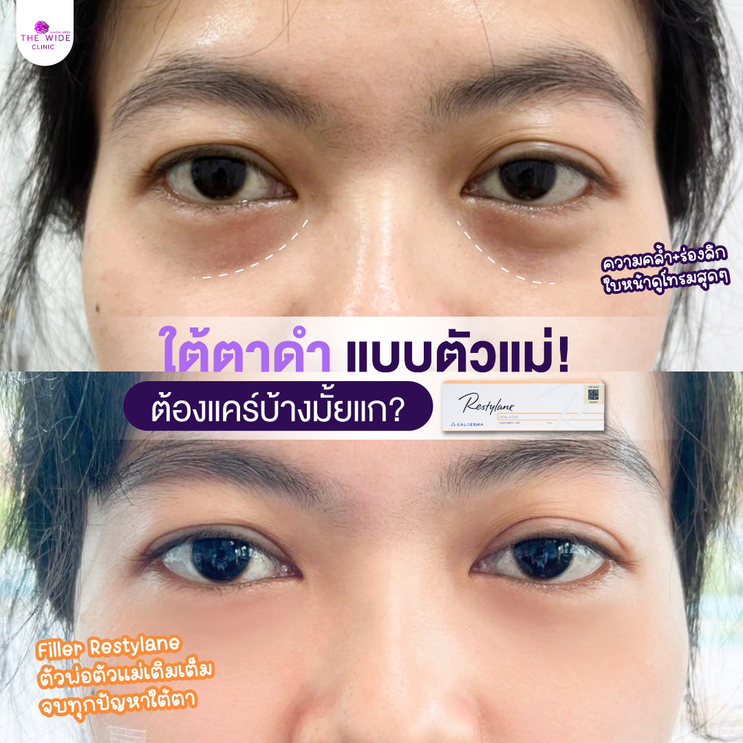 ฉีดฟิลเลอร์ พัทยา