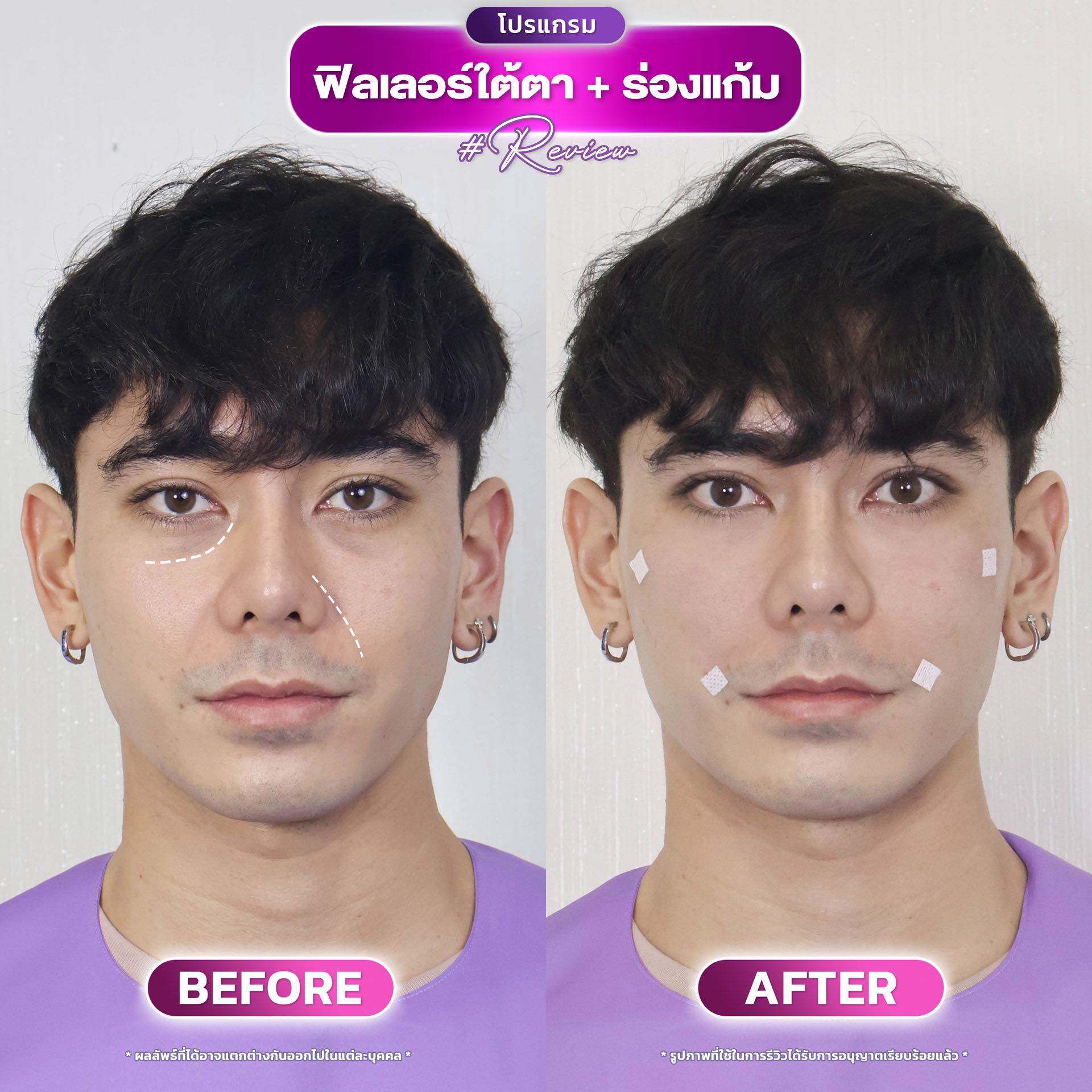 ฉีดฟิลเลอร์ จันทบุรี