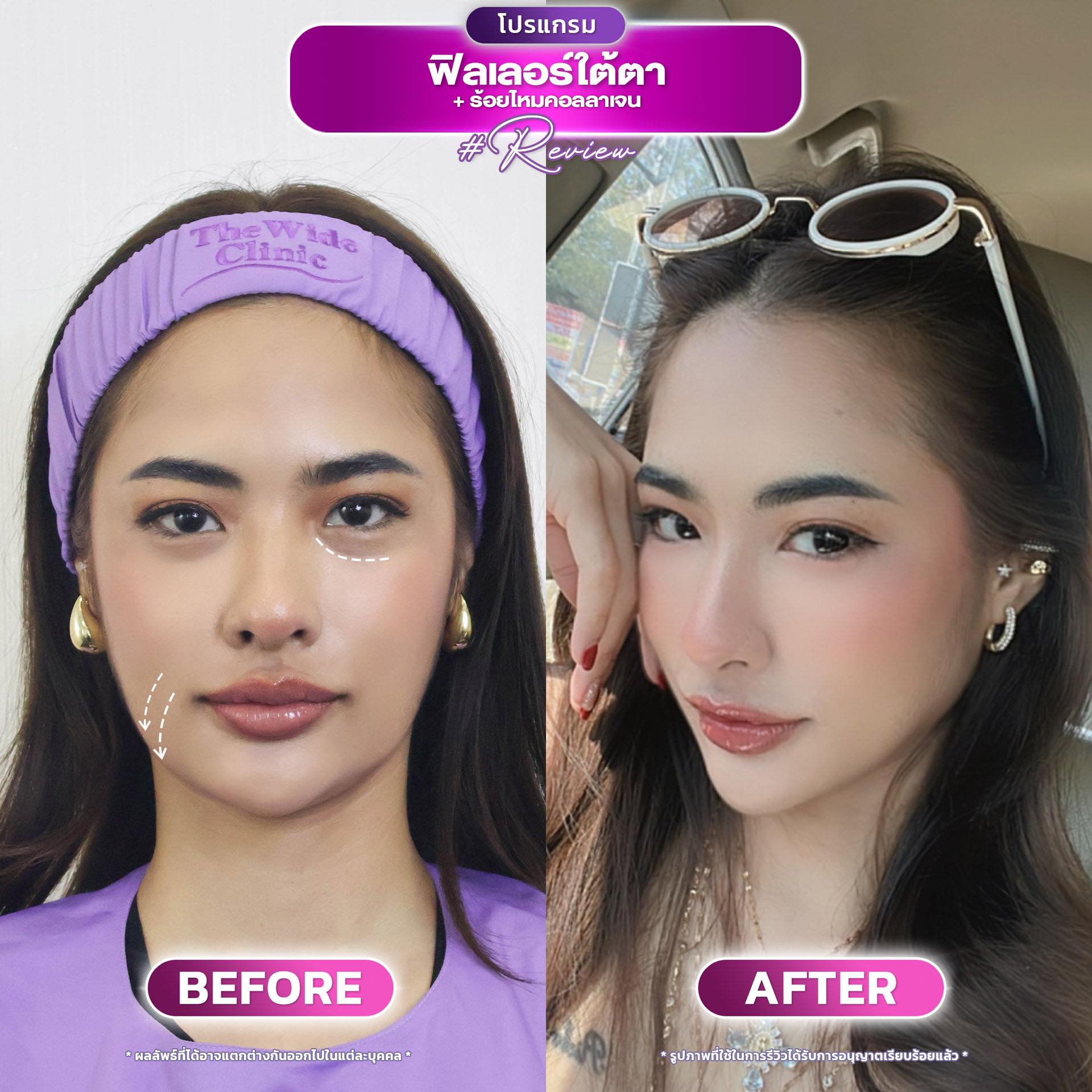 ฉีดฟิลเลอร์ จันทบุรี