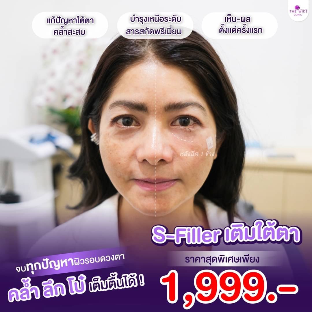 ฉีดใต้ตา